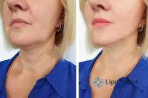Double chin before and after Hi-Fu treatment 4 Book your double chin treatment Brackley today! We are here to help!