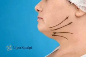 Double chin before and after Hi-Fu treatment 3 Boost your confidence with a Double chin treatment Brackley