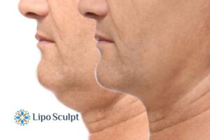Double chin before and after Hi-Fu treatment 2 Double chin treatment Brackley from Lipo Sculpt - feel more confident today!
