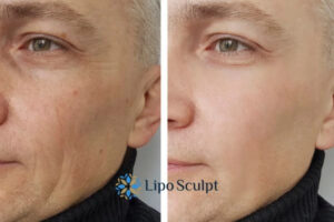 How to Fight Aging Symptoms 3 Fight Aging Symptoms Brackley With HIFU and Morpheus8 Today!