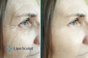 How to Fight Aging Symptoms 2 Do you want to Fight Aging Symptoms Brackley? Contact Lipo Sculpt today!