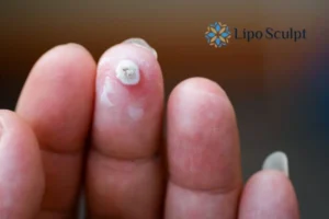 Cryopen Top 5 Treatable Conditions 4 Do you have a persistent wart of verruca that you cannot shit? Cryopen Brackley treatment will work call us NOW!