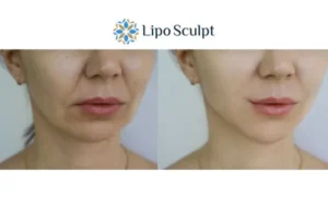 Explaining Total Skin Tightening Treatment And What It Can Do For You 2 Do you want to boost your self confidence? Give Morpheus8 Brackley a try today!