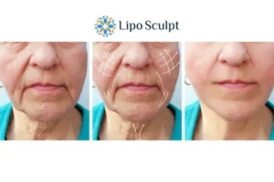 Explaining Total Skin Tightening Treatment And What It Can Do For You 3 Boost your confidence with Morpheus8 Brackley call our team today!