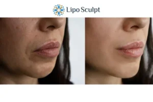 Explaining Total Skin Tightening Treatment And What It Can Do For You 4 Morpheus8 Brackley the best results - call our team today!