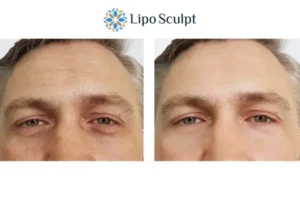 Explaining Total Skin Tightening Treatment And What It Can Do For You 6 Morpheus8 Brackley book in today to find out more!