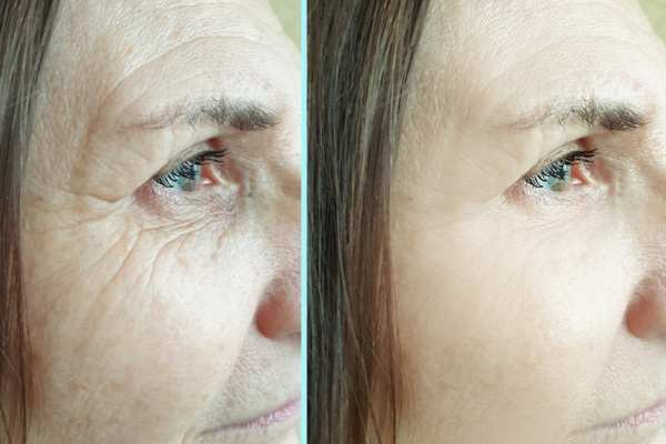 Why Do People Choose HIFU for a Non-Surgical Facelift? 4 How long can HIFU results last Brackley?