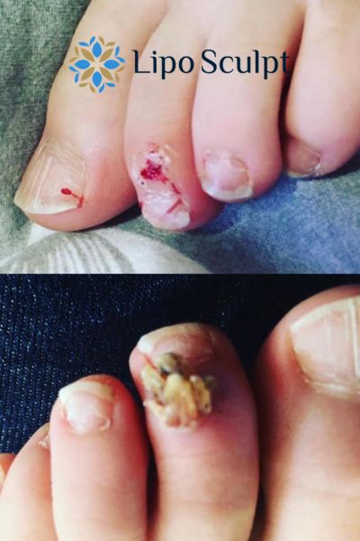 Wart removal customer results from Lipo Sculpt Brackley