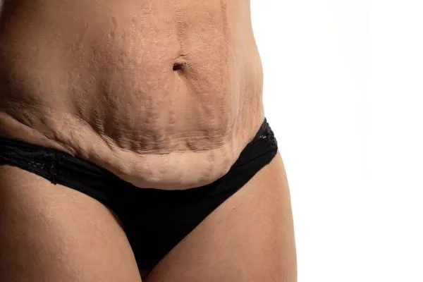 Lost the Weight but Not the Loose Skin? 1 image of womans stomach after weight loss showing loose skin Brackley