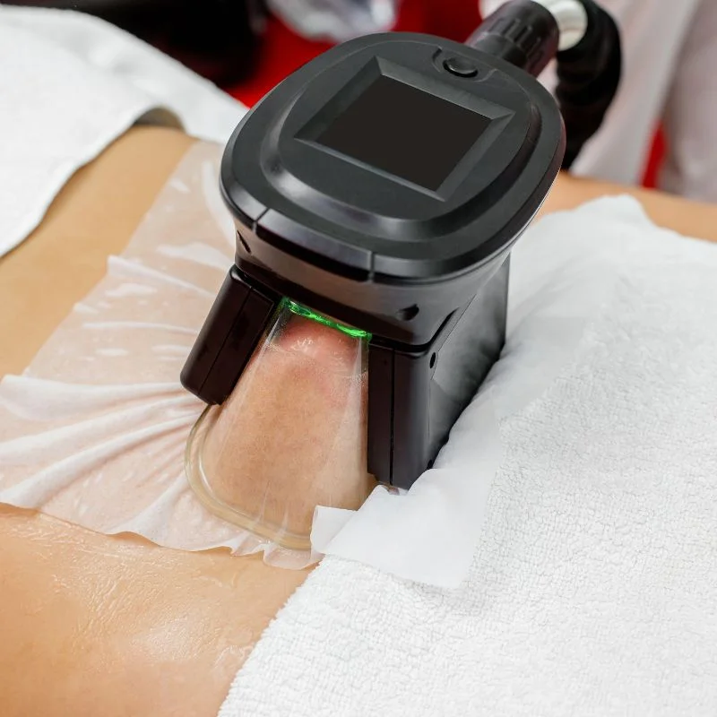 Fat Freezing treatment Brackley